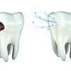 Tooth Cavity And Remineralization